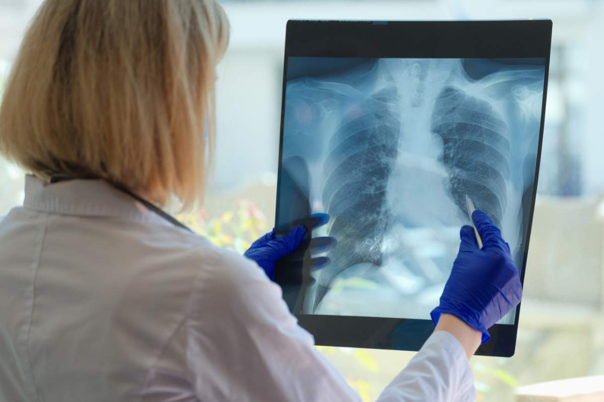 Nuova speranza contro il tumore: dall’Ue arriva la molecola miracolosa che allunga la vita dei pazienti 2 cancro ai polmoni molecola nuova