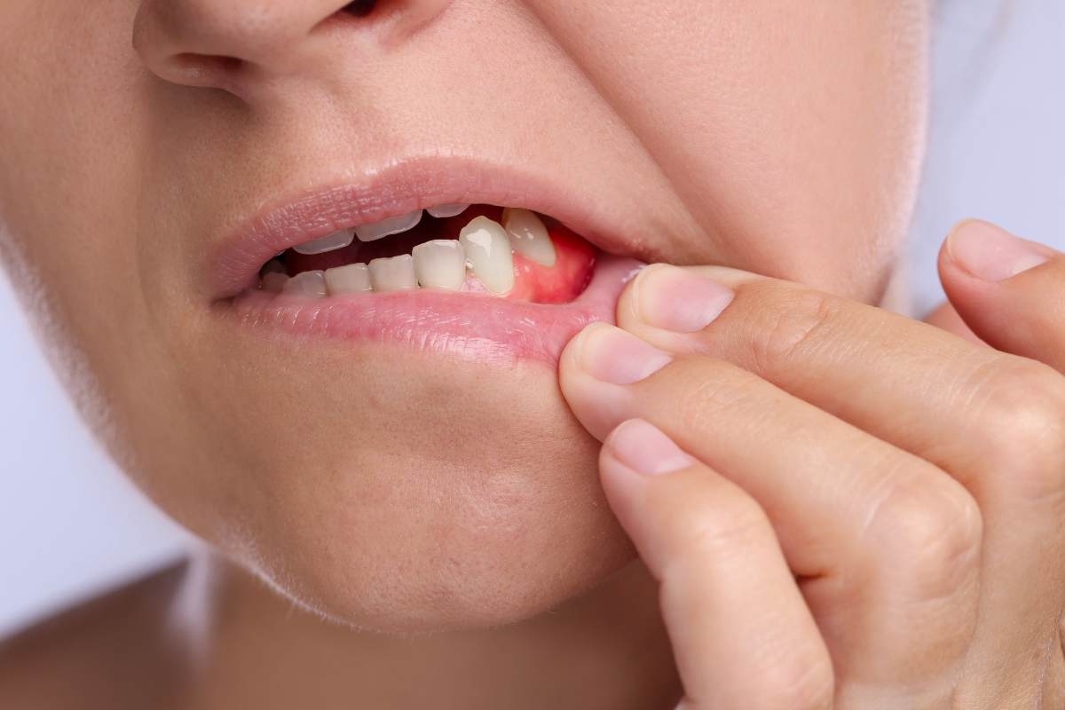 Dalle gengive parte un problema enorme che arriva fino al cuore