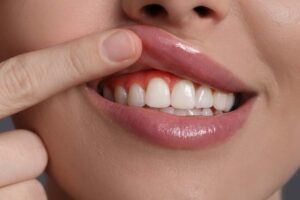 Dalle gengive parte un problema enorme che arriva fino al cuore